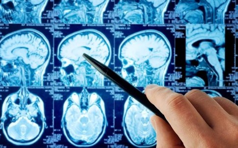 Trẻ 8 tuổi đã bị đột quỵ, dấu hiệu dễ nhầm lẫn với cảm cúm