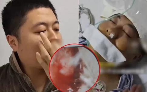 Mảnh xương vịt nằm trong phổi suốt 2 năm gây biến chứng nặng