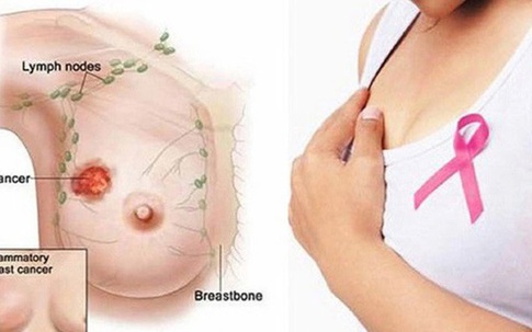 Thấy bất thường ở ngực, người phụ nữ 38 tuổi ở Hà Nội đi khám bất ngờ phát hiện khối u hiếm gặp