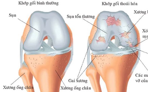 Người bệnh thoái hóa khớp gối tập luyện thế nào cho phù hợp?