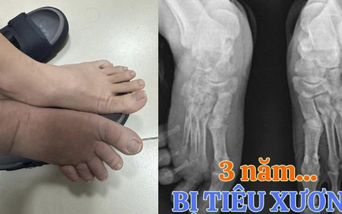 Chỉ sau cơn đau âm ỉ, người đàn ông tuyệt vọng vì bị "mất dần xương" và sự thật sau 3 năm đi tìm "thủ phạm"