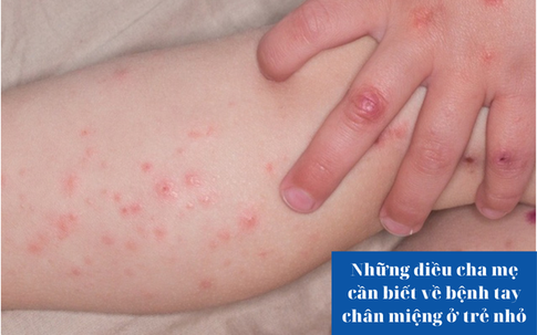 Những điều cha mẹ cần biết về bệnh tay chân miệng ở trẻ nhỏ