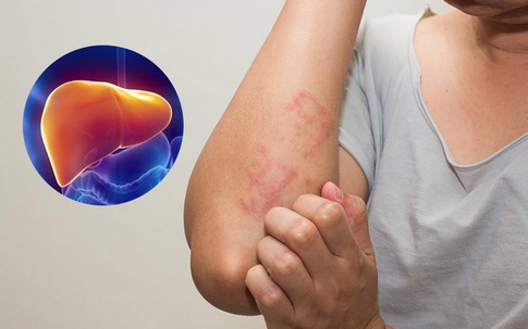 Mùa hè nắng nóng, khi nào nên thải độc gan, đây là 3 nhóm người cần cảnh giác