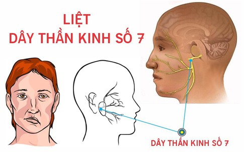 Thanh niên 27 tuổi ở Hà Nội bất ngờ bị liệt nửa mặt, bác sĩ chỉ rõ 'thủ phạm'