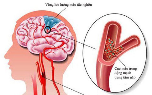 Người đàn ông ở Hà Nội phát hiện nhồi máu não từ dấu hiệu nhiều người Việt bỏ qua