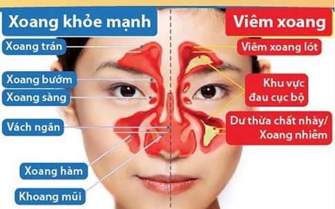 Cảnh báo nguy cơ viêm mũi xoang cấp từ một sai lầm nhiều người Việt mắc phải