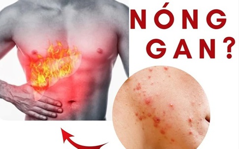 Mùa hè, 4 dấu hiệu cơ thể cảnh báo bạn đang bị nóng gan