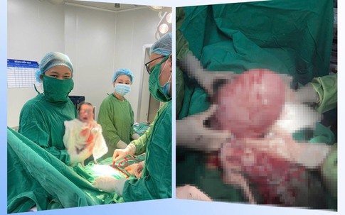 Người phụ nữ 30 tuổi vừa mang thai vừa có khối u xơ tử cung 'khủng' trong bụng