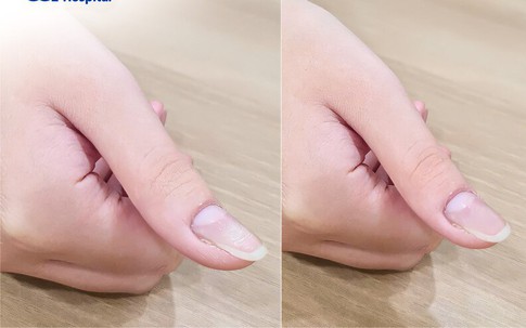 Đau ở ngón tay, bé 13 tuổi bất ngờ phát hiện bị u cuộn mạch, bác sĩ chỉ rõ có dấu hiệu này cần khám sớm