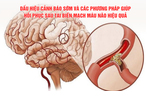 Dấu hiệu cảnh báo sớm và các phương pháp giúp hồi phục sau tai biến mạch máu não hiệu quả