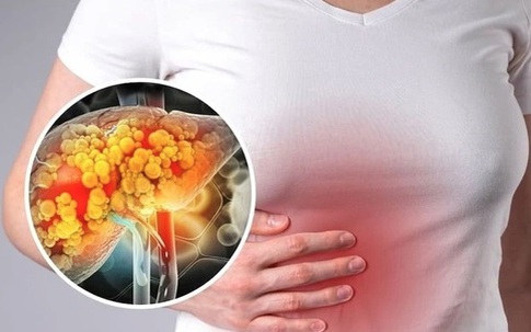 6 cách ngăn ngừa và kiểm soát bệnh gan nhiễm mỡ an toàn và hiệu quả