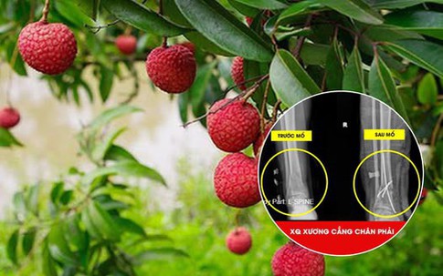 Người đàn ông 51 tuổi ở Phú Thọ nhập viện gấp sau khi trèo cây hái vải