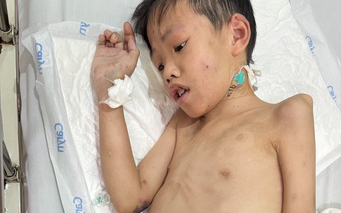 MS 1012: Con lớn bị tâm thần, người cha nghèo cầu cứu cộng đồng để điều trị cho con trai út mắc bệnh hiếm gặp