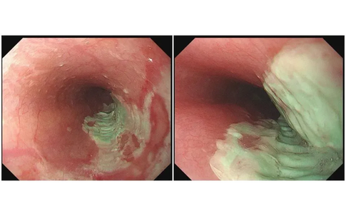 Người đàn ông 35 tuổi bị loét thực quản vì mắc sai lầm này khi uống thuốc