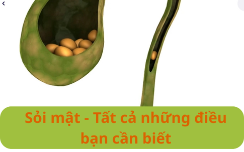 Sỏi mật - Tất cả những điều bạn cần biết