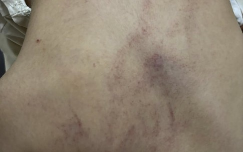 2 giáo viên ở Hà Nội bị đình chỉ công tác để điều tra vì nghi bạo hành dã man bé gái 4 tuổi
