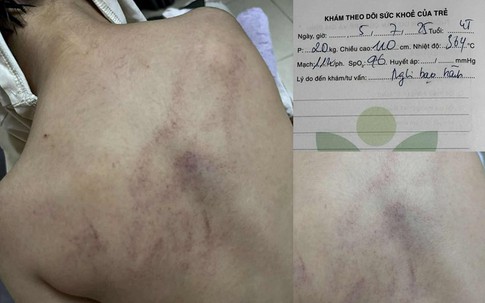 Bộ Y tế vào cuộc vụ bé gái 4 tuổi nghi bị cô giáo đánh đập, ném vào tường ở trường mầm non