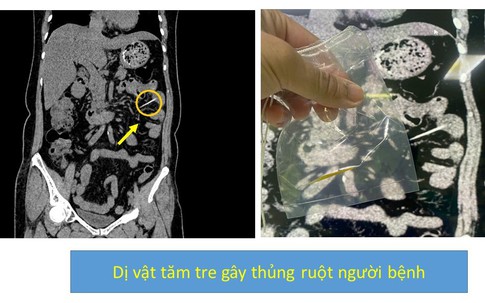 Liên tiếp 2 người ở Phú Thọ bị thủng đường tiêu hóa, bác sĩ cảnh báo thói quen nguy hiểm nhiều người mắc phải