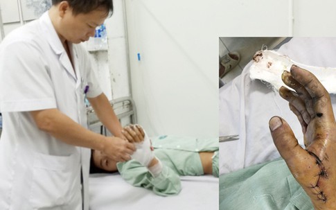 Học chế pháo theo hội nhóm trên mạng, trẻ suýt mất bàn tay