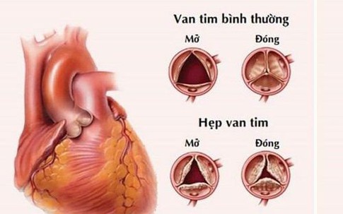 Người đàn ông ở Phú Thọ bị hỏng van tim, tự tin lên bàn mổ khi được bác sĩ áp dụng phương pháp ít xâm lấn