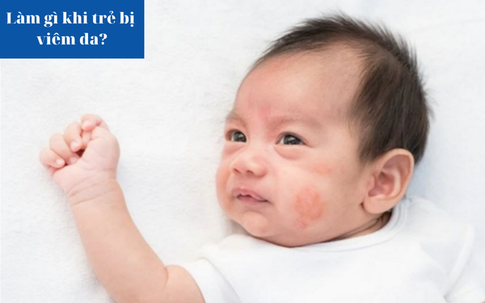 Làm gì khi trẻ bị viêm da?