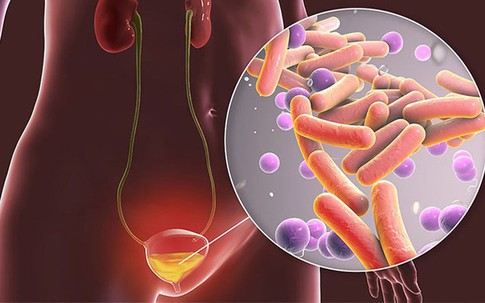 Người đàn ông 34 tuổi ở Thanh Hóa bị viêm bàng quang kéo dài, bác sĩ chỉ rõ biến chứng đáng sợ, cần cảnh giác