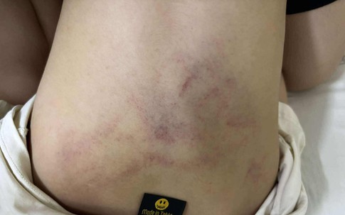 Điều tra vụ bé gái 4 tuổi nghi bị cô giáo bạo hành ở Hà Nội