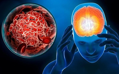 6 nhóm người nguy cơ đột quỵ cao, ai có dấu hiệu này cần cảnh giác!