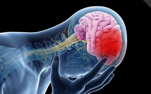 Đột quỵ: 'Sát thủ thầm lặng' khiến gần 50% người mắc không qua khỏi