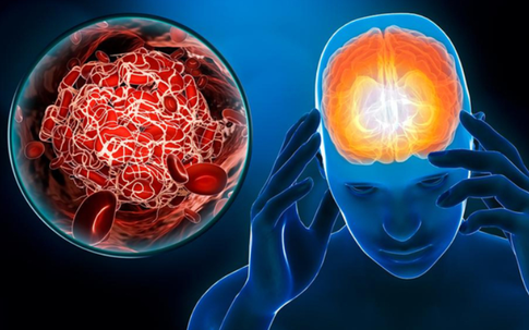 Đột quỵ và hội chứng ‘ngồi lâu’: Nguy hiểm hơn bạn tưởng