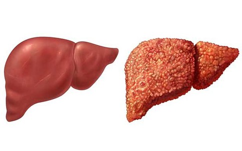Gan 'kêu cứu' mà bạn không hay biết: 10 dấu hiệu ai cũng dễ bỏ qua