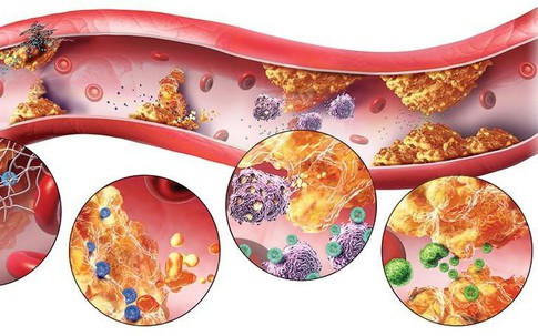 Phòng ngừa đột quỵ, nhồi máu cơ tim trước tuổi 40: Cảnh giác với dấu hiệu hội chứng chuyển hóa