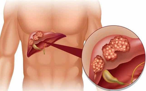 Thông tin cần biết về biến chứng gan ở người tiểu đường