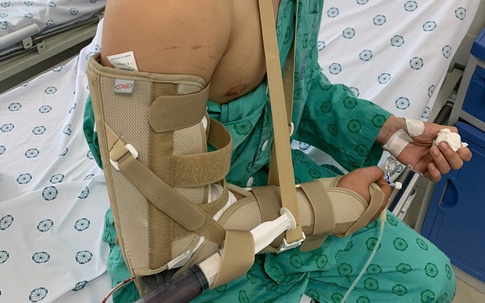 Chơi vật tay với bạn, thanh niên 18 tuổi ở Hà Nội bị gãy xương