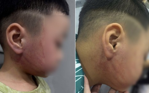 Bé 4 tuổi nghi bị giáo viên mầm non ở Hà Nội đánh bầm tím mặt