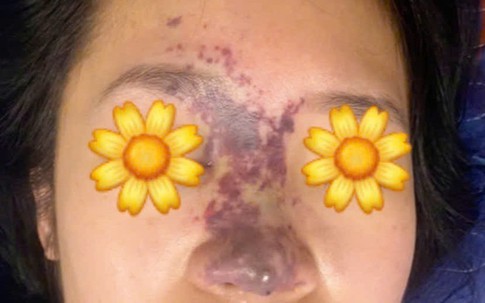 Tiêm filler trôi nổi, có người phải trải qua hơn 60 ca phẫu thuật để xử lý hậu quả