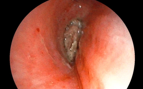 Người phụ nữ 57 tuổi ở Hà Nội tức ngực, bác sĩ nội soi gắp ra thứ 'đáng sợ' bên trong