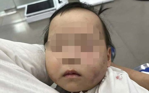 Bé gái 1 tuổi bị bầm tím mặt khi gửi nhà trẻ ở Bắc Ninh: Công an tạm giữ cô giáo
