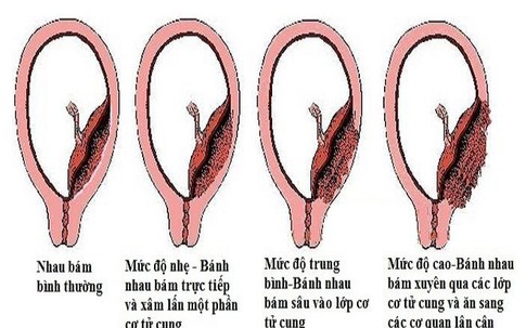 Thận trọng với nhau cài răng lược khi mang thai