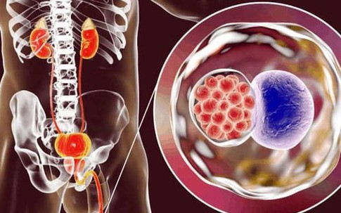 3 bệnh lây truyền qua đường tình dục làm tăng nguy cơ ung thư cổ tử cung