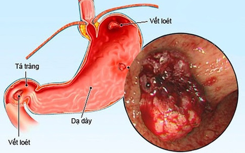 Áp lực mùa thi, nam sinh 15 tuổi hai lần nhập viện vì loét dạ dày