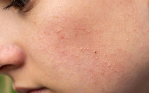 Mụn ẩn dưới da: “Kẻ thù vô hình” của làn da và 3 bước xử lý hiệu quả