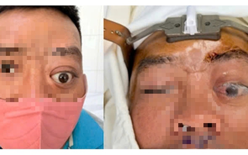 Một ca bệnh mà Bệnh viện Tai Mũi Họng TPHCM mới gặp lại trong vòng 20 năm