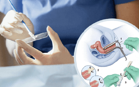 Khi nào nên làm xét nghiệm Pap để sàng lọc ung thư cổ tử cung?