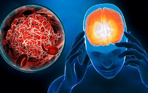 Đột quỵ não giai đoạn sớm không phải đau đầu, mà là 4 dấu hiệu này