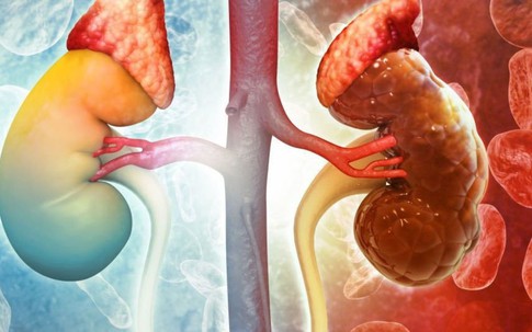 Đừng đợi đến khi chạy thận mới hối hận: 5 tín hiệu 'cầu cứu' từ thận bị 90% người bệnh bỏ qua