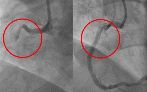 Người đàn ông bất ngờ bị ngưng tim nguy kịch