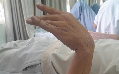 Ngủ gật trên bàn làm việc 30 phút, người đàn ông 'tá hoả' khi phát hiện tay bị liệt