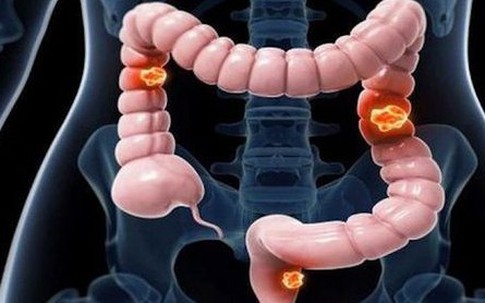Nam sinh viên 22 tuổi mắc ung thư đại tràng giai đoạn 4 thừa nhận bỏ qua 3 dấu hiệu báo bệnh này