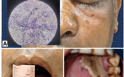 Người đàn ông ở Phú Thọ mắc bệnh tiểu đường bị hôn mê nguy kịch do nấm đen xâm lấn não